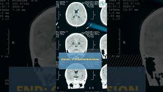 Functional Neurologic Disorder FND  MCAshorts [upl. by Onimixam893]