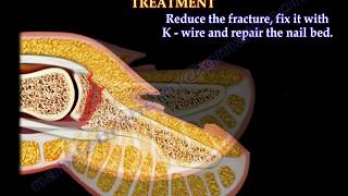 Seymour fracture of the fingers  Everything You Need To Know  Dr Nabil Ebraheim [upl. by Haron238]