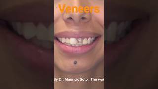 Composite Veneers by the World Best Dr Mauricio Soto [upl. by Wenz693]