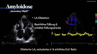 〖Echokardiografie〗 Amyloidose  HFpEF Phänotyp🫀 [upl. by Eneleuqcaj]