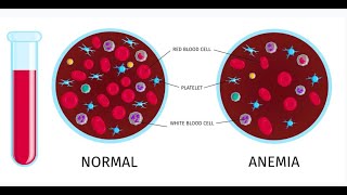 Anemia  cu doamna doctor Ionela Adriana Vladutu medic specialist medicina interna [upl. by Osrit]