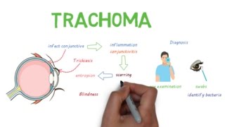 Trachoma  a devastating infectious eye disease [upl. by Nauqas177]