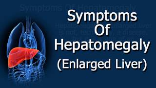 Symptoms Of Hepatomegaly Enlarged Liver [upl. by Akceber]