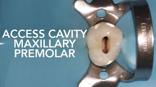 Pre Clinical Endodontic  Access Cavity of Maxillary Premolar [upl. by Eetnuahs]