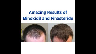 Minoxidil and Finasteride 5 Topical Solution  Before and After Result  One Month Journey [upl. by Joline]