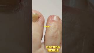 Is It Safe to Pop a Blister The Shocking Facts You Need to Know [upl. by Burke]