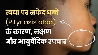 Can I Get Rid of Pityriasis Alba Naturally [upl. by Nhar974]