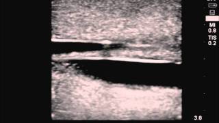 Transparent Ultrasound CVC Training Model [upl. by Auqinet]