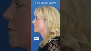 NECK TRANSFORMATION Facelift for a Tighter Sculpted Neck [upl. by Adnilrem]