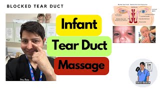 Tear Duct Massage Crigler For Infants for Blocked Tear Duct Crigler tearductobstruction [upl. by Kcub237]