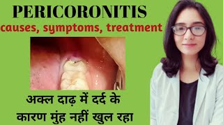 Pericoronitis causes symptoms and treatmentअक्ल दाढ़ के दर्द का कारण और इलाजमुंह कम खुलने का इलाज [upl. by Morez]