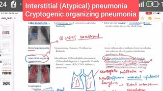 Interstitial Atypical pneumonia and Cryptogenic organizing pneumoniaRespiratory 49  USMLE step 1 [upl. by Adina516]