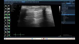 IQ 320 TFAST LUNG ULTRASOUND ECHOPAC ANALYSIS 3 [upl. by Lebasy443]