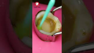 Removing Tooth Decay ASMR shorts [upl. by Eelatsyrc]