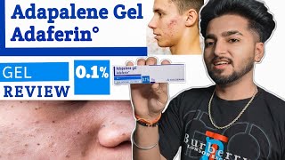 Adapalene Gel Adaferin 01 Review In Hindi  Best Gel For Removing Blackheads and Whiteheads [upl. by Brahear]