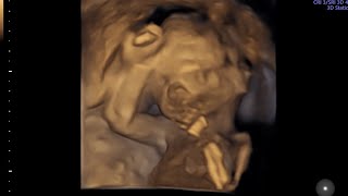 18 weeks  NO GENDER 2D4D baby bonding ultrasound scan [upl. by Hplodur116]