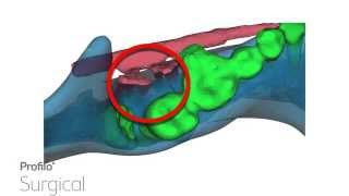 IMDO explained for overbite treatment [upl. by Ahsenahs]