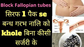 fellopian tube blockage in hindi  fellopian tube blockage treatment heenhaealth [upl. by Erna]