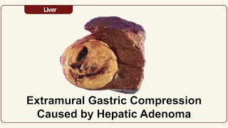 Extramural Gastric Compression Caused by Hepatic Adenoma [upl. by Tavis566]