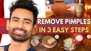 ULTIMATE Ayurvedic Routine to Get Rid of Pimples amp Acne Permanently Men amp Women [upl. by Colwin]