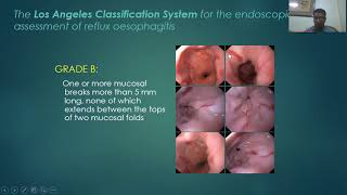 Gastroesaphageal Reflux Disease By DR MohammedHussien [upl. by Dracir]