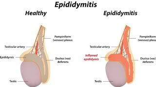 Epididymitis treatment in hindi or english [upl. by Udella259]