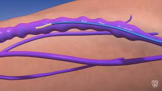 Guiding Light An Animated Journey through Endovenous Thermal Ablation [upl. by Esydnac161]