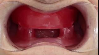 Occlusal registration for complete dentures demonstrating a reproducible occluding position [upl. by Lorraine]