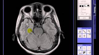 BRAIN MRI Multiple lacunar infarcts [upl. by Root]