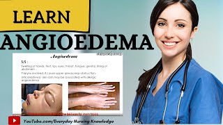 Learn About Angioedema I Everyday Nursing Knowledge [upl. by Lotte673]