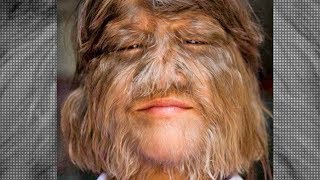 Hypertrichosis Do Werewolves Really Exist [upl. by Nniw733]