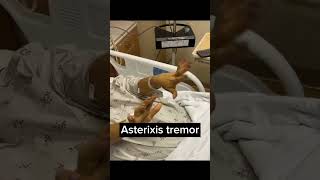 Asterixis flapping hand tremor asterixflappingtremoricucardiologistashortvideohandtremor [upl. by Novek]