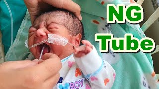 Nasogastric NG Tube Insertion in NeonateNewborn  Orogastric OG TubeFeeding Tube  Paediatric [upl. by Nauqet]