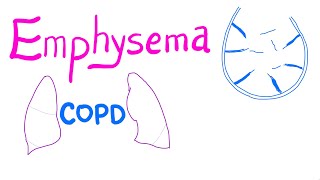 Emphysema  COPD  Pulmonary Medicine [upl. by Shea666]