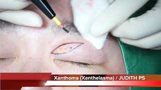 Xanthoma Xanthelasma removal surgery 안검황색종 [upl. by Nayarb687]