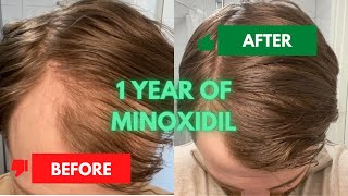 1 Year of Using Minoxidil  My Hair Growth Journey  Before amp After Results [upl. by Annohsak392]