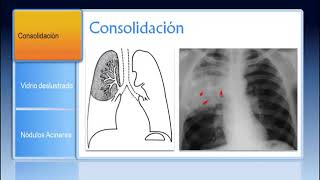 Patrones Pulmonares en Radiología y TC [upl. by Augustin]