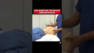 LMA Insertion Technique Demonstration  shorts airway LMA [upl. by Luther]