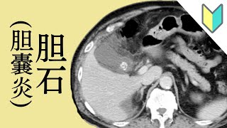 【おきらく版】第９回：胆石（胆嚢炎） 胆嚢結石で胆嚢炎を起こしたCT画像 [upl. by Eceeryt]