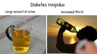 Diabetes insipidus Symptoms causes and treatment Diabetes insipidus vs diabetes mellitus [upl. by Ahseenat]