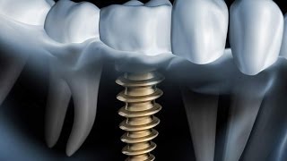 Welches Zahnimplantat System ist das beste [upl. by Haggai]