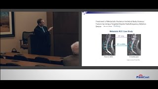 LECTURE SERIES PREVIEW Vertebral Augmentation Slide Presentation by Dr Matthew Rupert [upl. by Ardys]