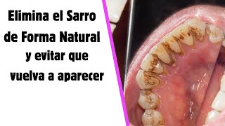 🦷 Elimina la Placa Dental Sarro con Este Remedio Casero Efectivo 💥 [upl. by Arihsat]