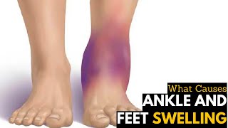 What Causes Ankles amp Feet Swelling  Diagnosis amp Treatment [upl. by Anigroeg]