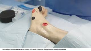 Application tips 3M™ VAC® Dressing Application Bridging Technique on Foot Wound [upl. by Gravante]