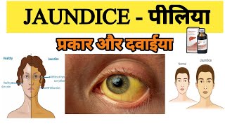 Jaundice treatment  Types of Jaundice  Symptoms of Jaundice  What is main cause of jaundice [upl. by Carmela]