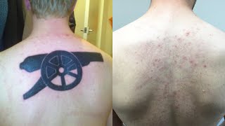 Laser Tattoo Removal  Does laser tattoo removal hurt [upl. by Ekihc]