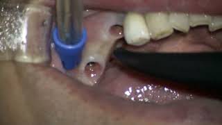 Straumann 2 BLT final set in posterior mandible [upl. by Alvita976]