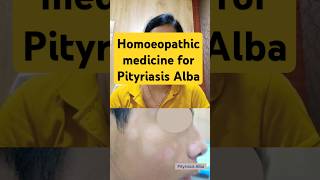 Pityriasis Alba homoeopathicmedicine skin safeddaagkailaj vitiligotreatment leucoderma [upl. by Emmery]