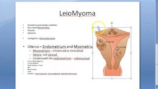 Pathology 721 a Leiomyoma FIBROID uterus fibromyoma Smooth muscle benign Gross specimen Practical [upl. by Erreip153]